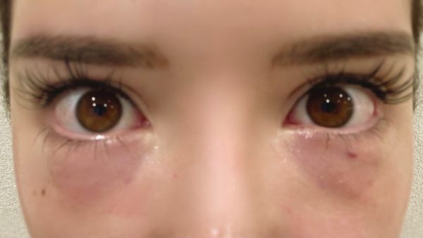 スネコスとは 効果やメリット 目の下のクマ 首の症例を紹介