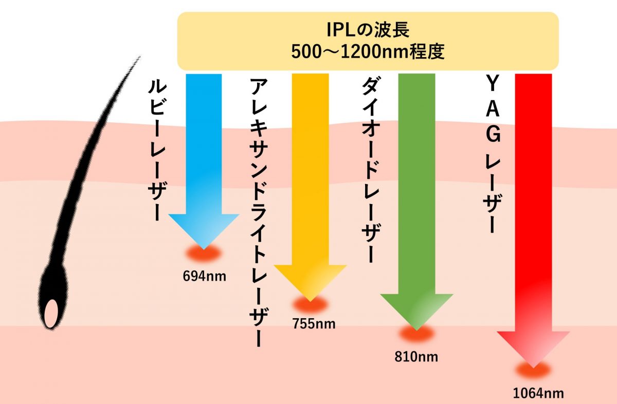 医療脱毛の機械を悩み別に提案！レーザーや照射方法の違いも紹介
