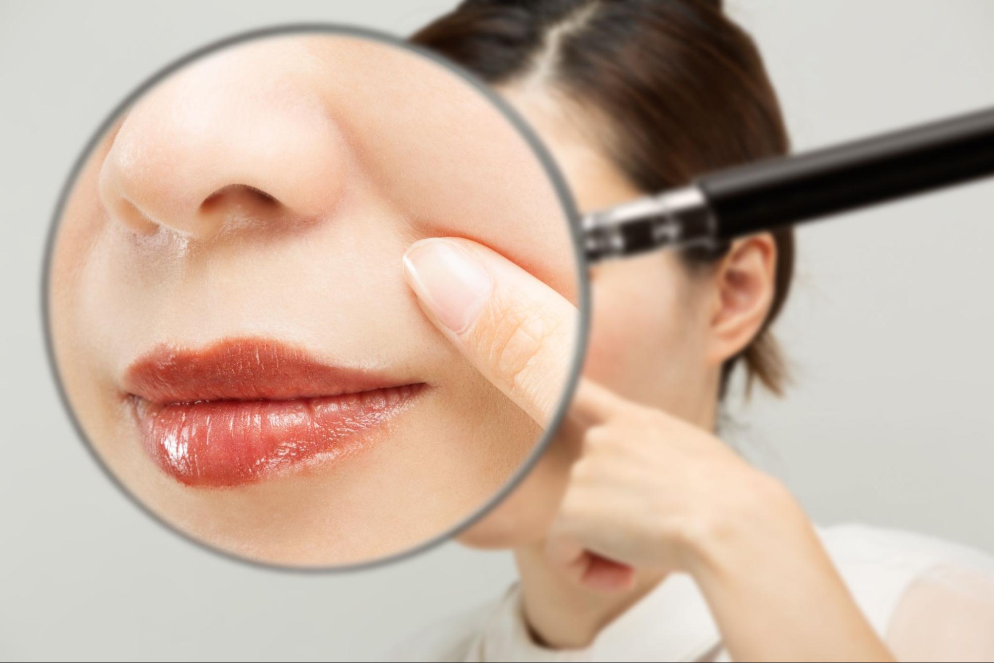 ほうれい線の拡大