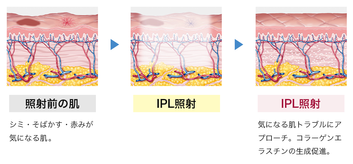 ステラM22の照射前と照射後の肌の変化のイラスト