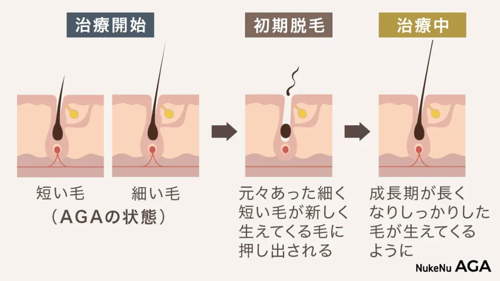 初期脱毛