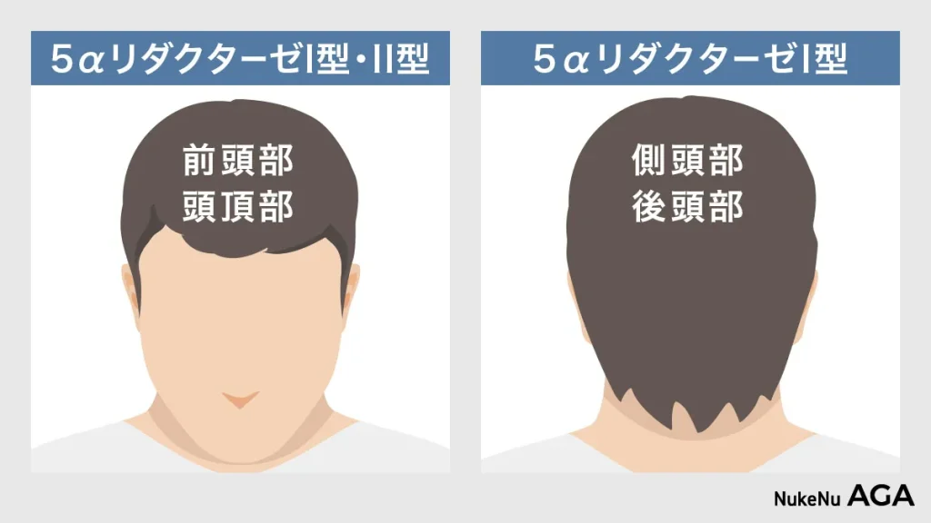 5α-リダクターゼ「Ⅰ型」「Ⅱ型」の頭部の分布図