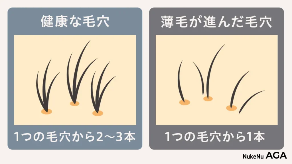 正常な毛穴と薄毛の毛穴