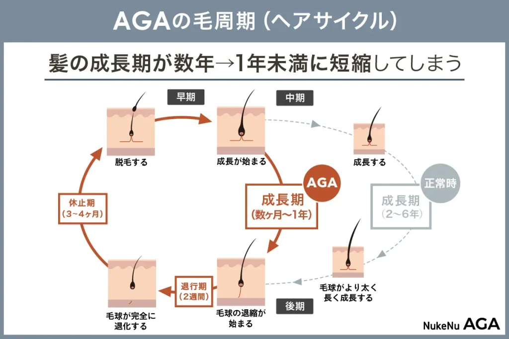 つむじはげの原因①AGA