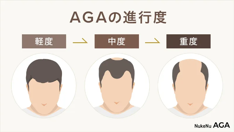 AGAの進行度