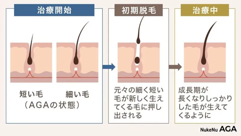 AGAの初期脱毛