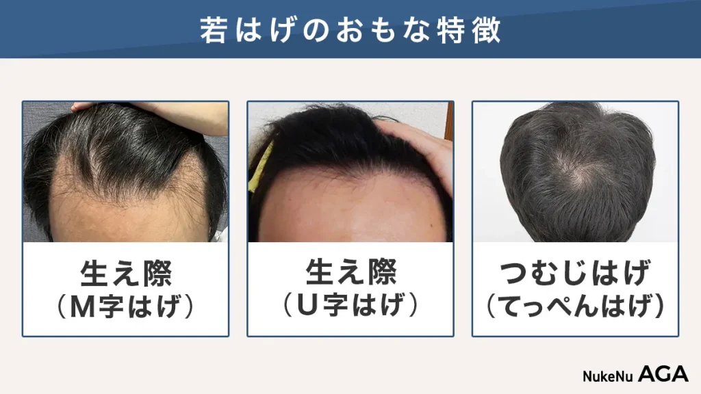 若はげの進行パターン3種類
