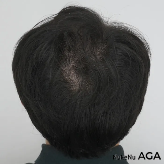 AGA治療の頭頂部の症例（1ヶ月）