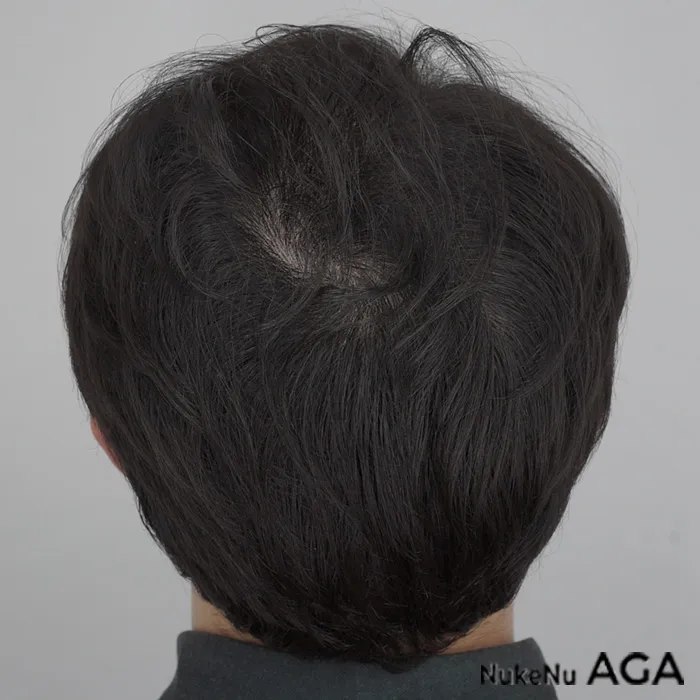 AGA治療の頭頂部の症例（3ヶ月）