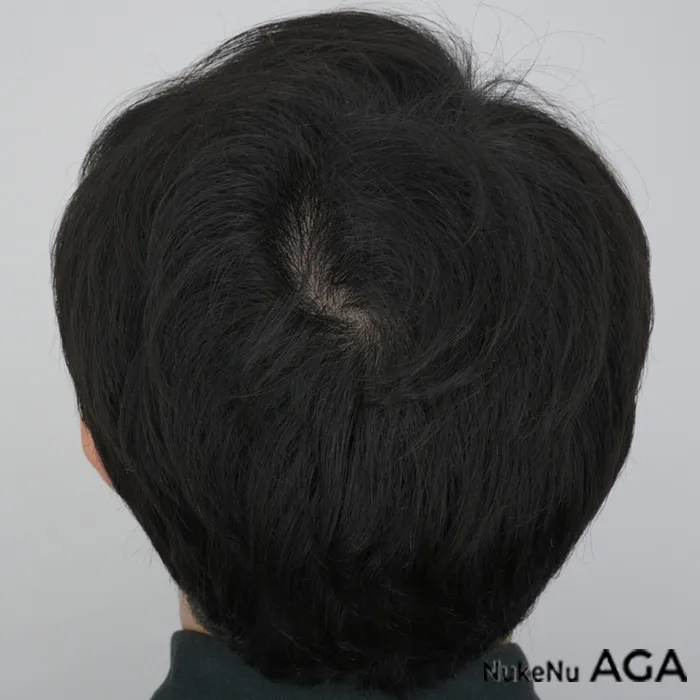 AGA治療の頭頂部の症例（6ヶ月）
